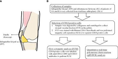 Increased Ratio of CD14++CD80+ Cells/CD14++CD163+ Cells in the Infrapatellar Fat Pad of End-Stage Arthropathy Patients